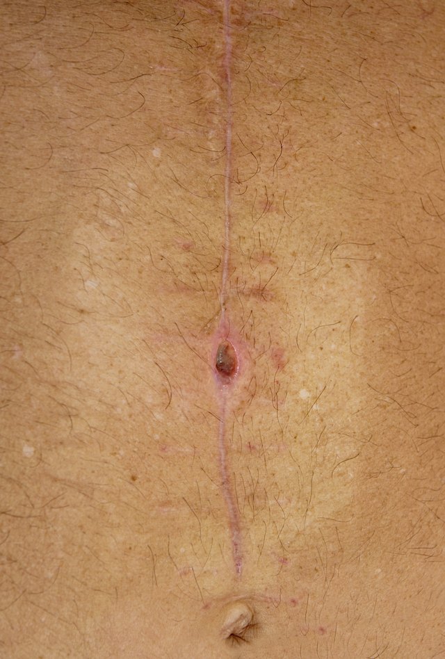 staph infection topical treatment for staph infections with pictures ehow staph infection topical treatment for staph infections with pictures ehow