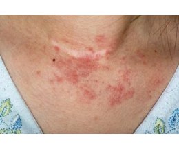 Lip eczema - Atopic Skin Disease