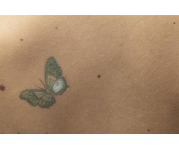 can you tattoo over acne with pictures ehow can you tattoo over acne with pictures ehow