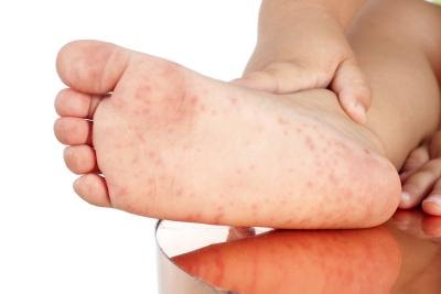 Le massage à la varice variqueuse sur les pieds