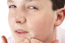 Pimple extractors help simplify skin care.