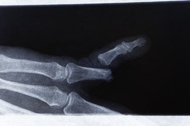 X-Ray Broken Finger
