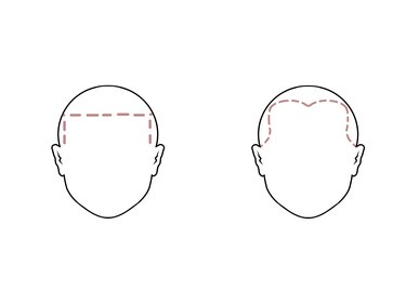 Outline of two heads with red dotted lines marking hairlines