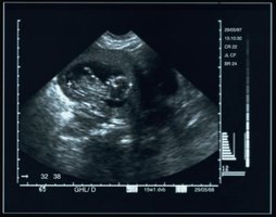 Fluid on the Brain of an Unborn Baby | eHow