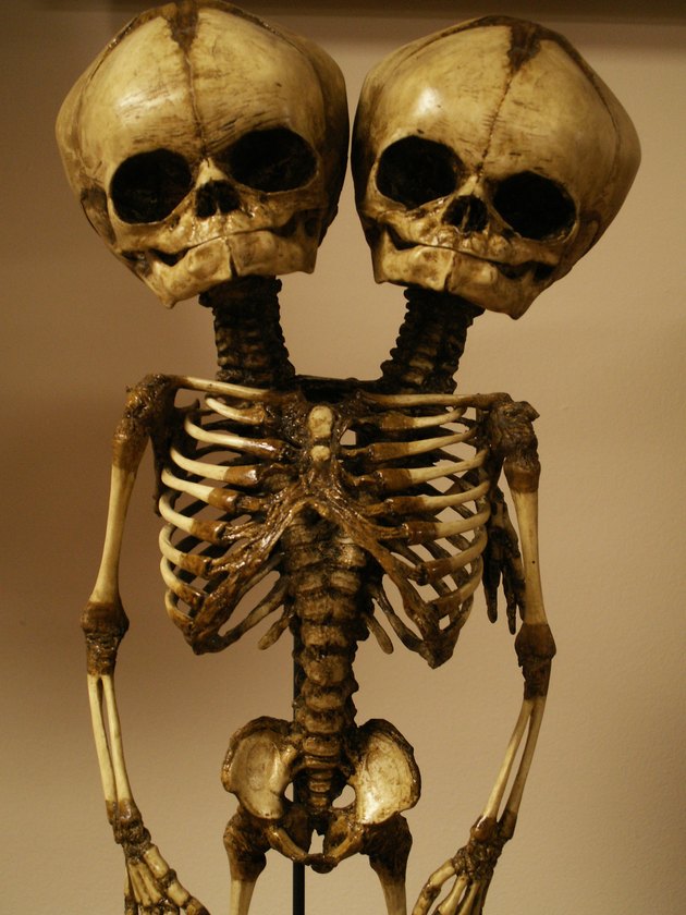 skeleton of conjoined twins