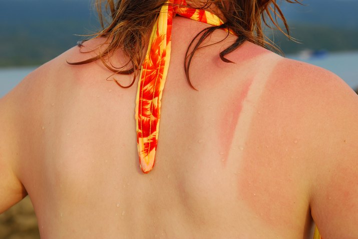 Sunburned back