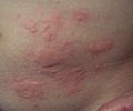 What Kind of Skin Rashes Can Mold Cause? | eHow