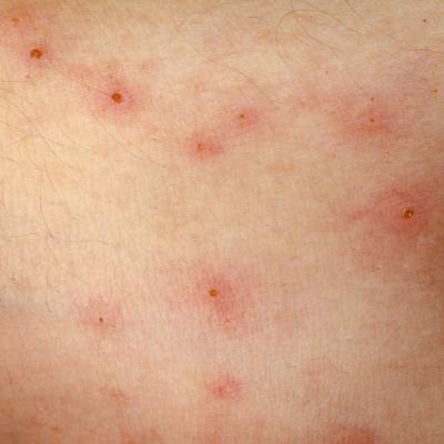 Symptoms of Shingles on Face | eHow